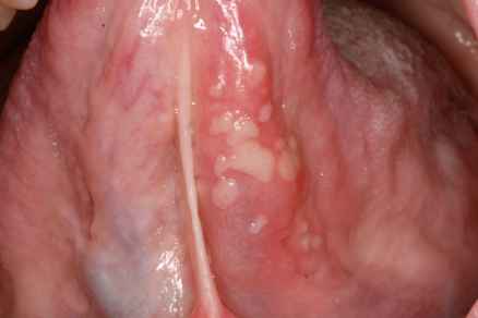 Bumps on Tongue – Causes, Treatment, Pictures